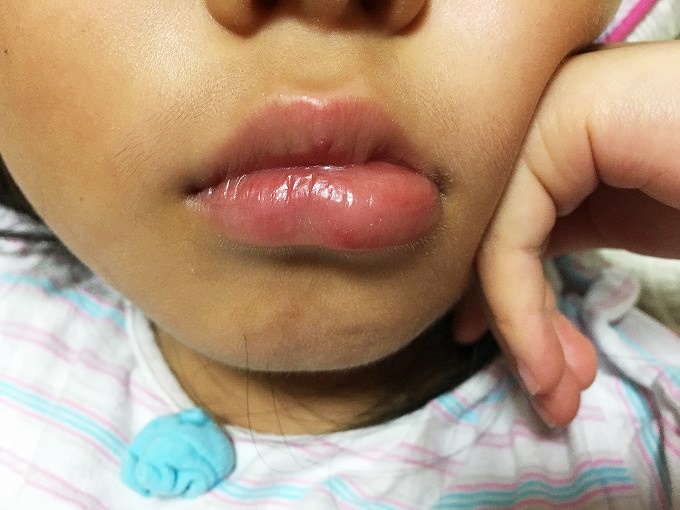 子供の下唇が急に腫れて病院へ 診察結果や治療方法などをご紹介 ゆうゆうブログ