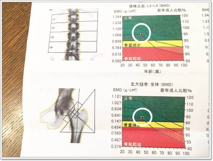 骨密度検査の検査結果