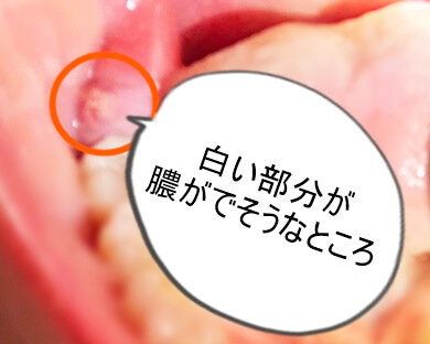 奥歯の歯茎が腫れた状態